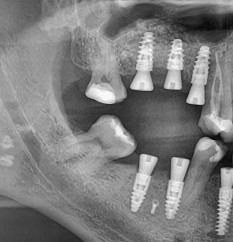 Stan po wszczepieniu implantów